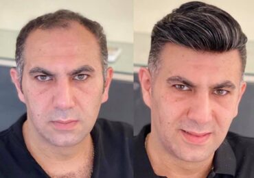 men hair replacement